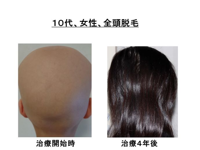円形脱毛症　病院